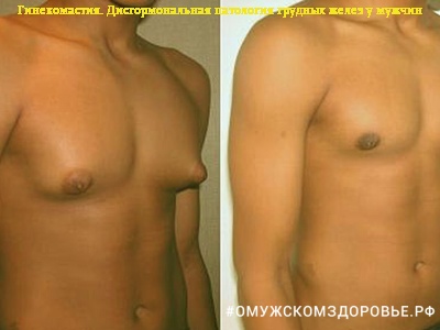 Гинекомастия. Дисгормональная патология грудных желез у мужчин