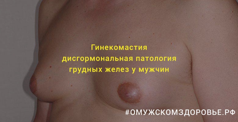 Гинекомастия. Дисгормональная патология грудных желез у мужчин