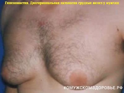 Фото мужчины с гинекомастией