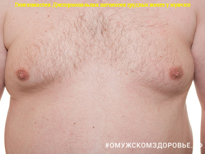 Дисгормональная гиперплазия грудных желез