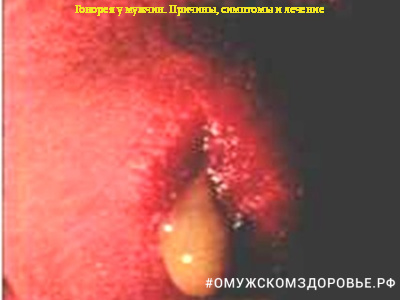 Гонорея у мужчин. Причины, симптомы и лечение