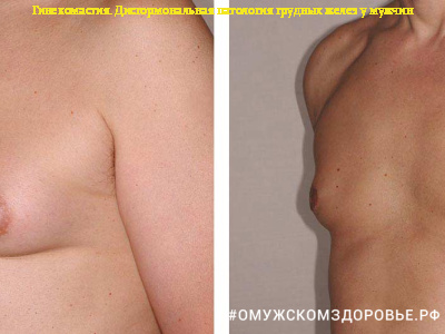 Гинекомастия. Дисгормональная патология грудных желез у мужчин