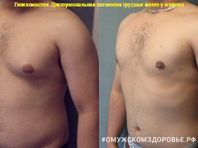 Гинекомастия. Дисгормональная патология грудных желез у мужчин