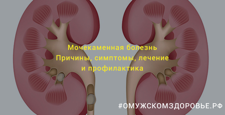 Мочекаменная болезнь у мужчин. Причины, симптомы, лечение и профилактика