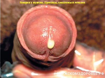 Гонорея у мужчин. Причины, симптомы и лечение
